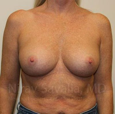 Thigh Lift Before & After Gallery - Patient 1655444