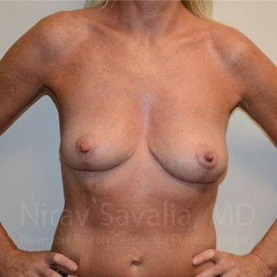 Mommy Makeover Before & After Gallery - Patient 1655456 - After