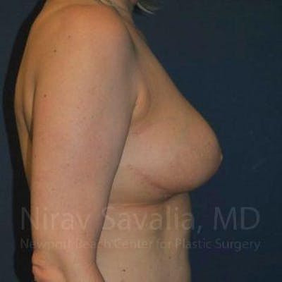 Breast Explantation En Bloc Capsulectomy Before & After Gallery - Patient 1655461 - After