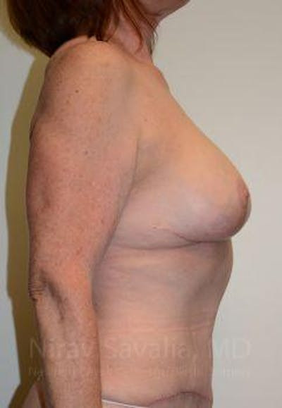 Breast Explantation En Bloc Capsulectomy Before & After Gallery - Patient 1655458 - After