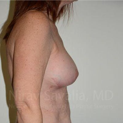 Mastectomy Reconstruction Before & After Gallery - Patient 1655467 - After