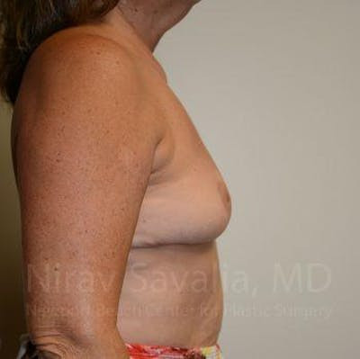 Chin Implants Before & After Gallery - Patient 1655471 - After