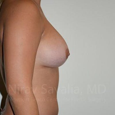 Breast Lift without Implants Before & After Gallery - Patient 1655477 - After