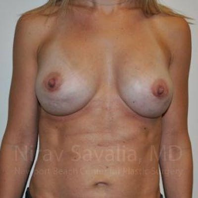 Breast Explantation En Bloc Capsulectomy Before & After Gallery - Patient 1655478