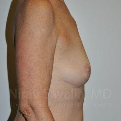 Mastectomy Reconstruction Before & After Gallery - Patient 1655481 - After