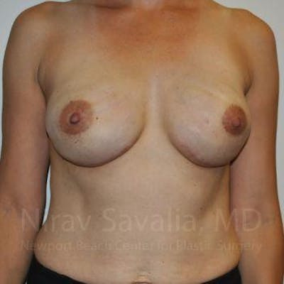 Breast Explantation En Bloc Capsulectomy Before & After Gallery - Patient 1655492