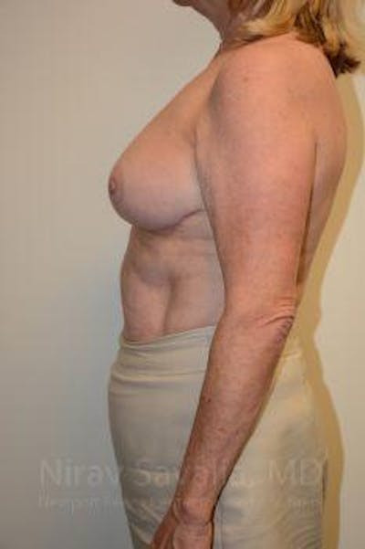 Breast Lift with Implants Before & After Gallery - Patient 1655496 - After