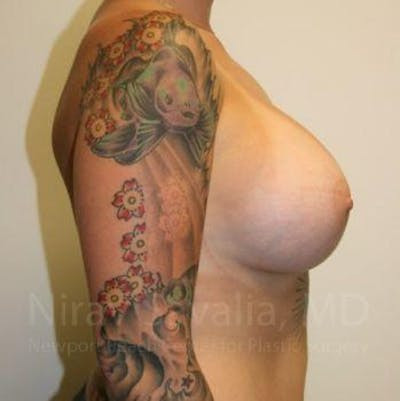 Mastectomy Reconstruction Before & After Gallery - Patient 1655500 - After