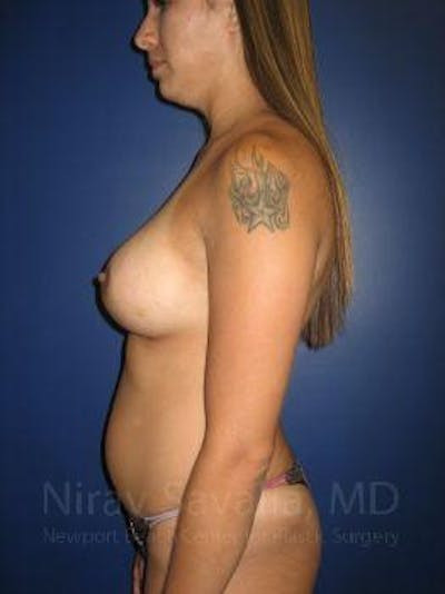 Oncoplastic Reconstruction Before & After Gallery - Patient 1655508 - After