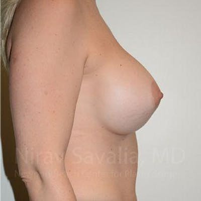 Breast Reduction Before & After Gallery - Patient 1655512 - After