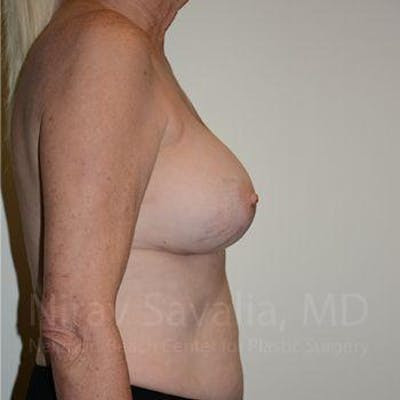 Breast Reduction Before & After Gallery - Patient 1655513 - After