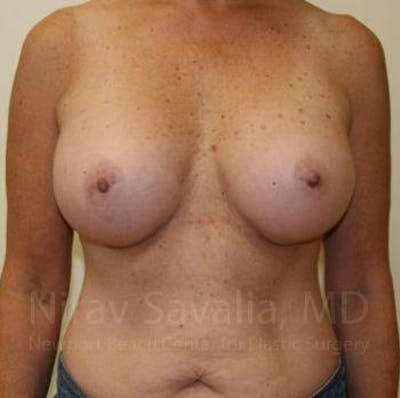 Breast Explantation En Bloc Capsulectomy Before & After Gallery - Patient 1655519