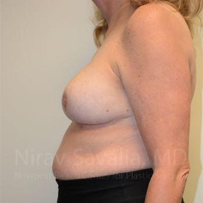 Breast Lift with Implants Before & After Gallery - Patient 1655533 - After