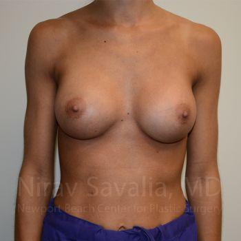 Chin Implants Before & After Gallery - Patient 1655548 - After