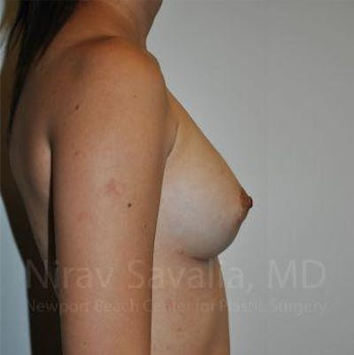 Mastectomy Reconstruction Before & After Gallery - Patient 1655564 - After