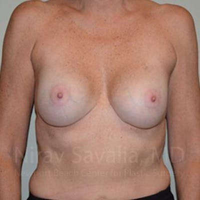 Chin Implants Before & After Gallery - Patient 1655570