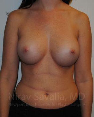 Breast Explantation En Bloc Capsulectomy Before & After Gallery - Patient 1655574