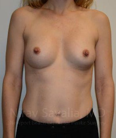 Chin Implants Before & After Gallery - Patient 1655580 - After