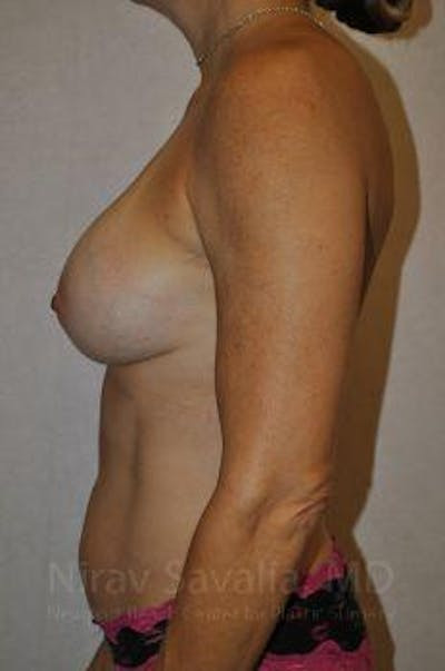 Breast Lift without Implants Before & After Gallery - Patient 1655594 - After