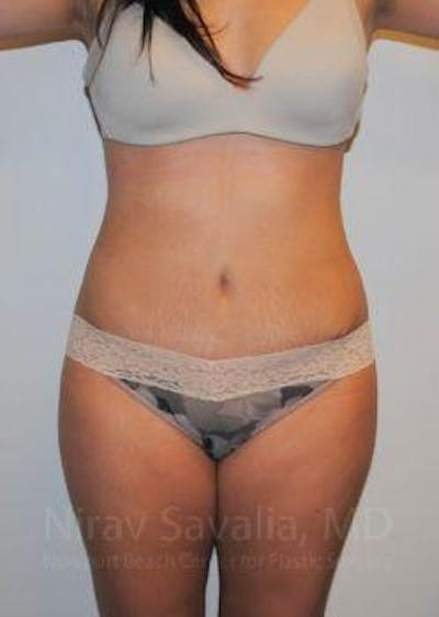 Breast Lift with Implants Before & After Gallery - Patient 1655598 - After