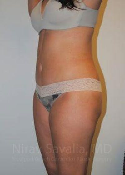 Liposuction Before & After Gallery - Patient 1655598 - After