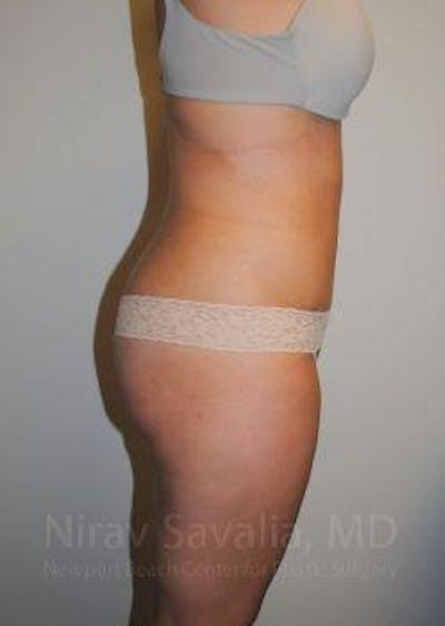 Thigh Lift Before & After Gallery - Patient 1655599 - After