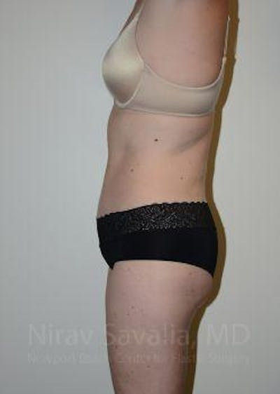 Thigh Lift Before & After Gallery - Patient 1655605 - After