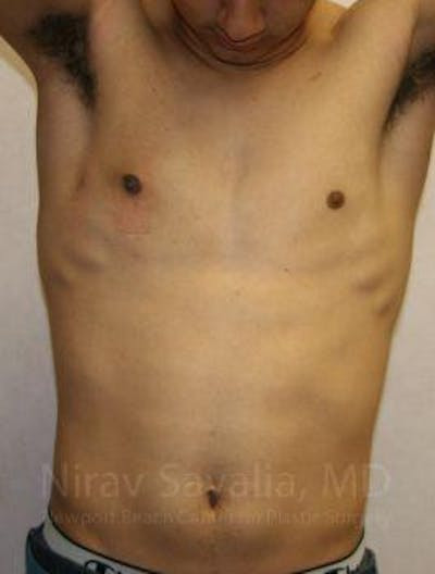 Breast Explantation En Bloc Capsulectomy Before & After Gallery - Patient 1655607 - After