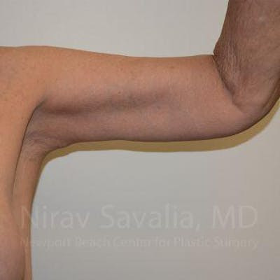 Thigh Lift Before & After Gallery - Patient 1655610 - After
