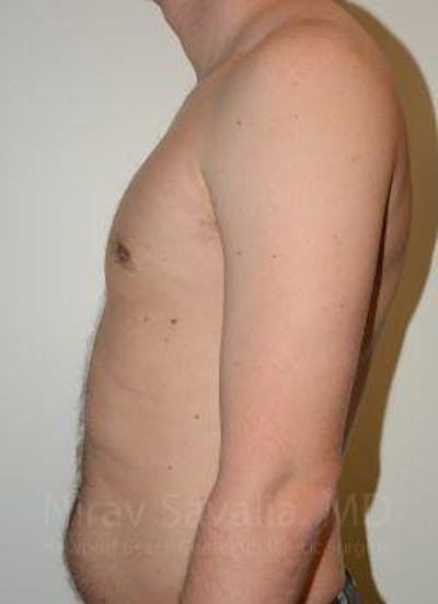 Mastectomy Reconstruction Before & After Gallery - Patient 1655612 - After