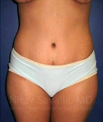 Thigh Lift Before & After Gallery - Patient 1655614
