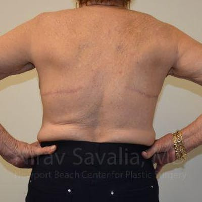 Thigh Lift Before & After Gallery - Patient 1655616