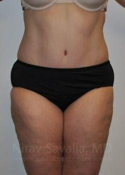 Thigh Lift Before & After Gallery - Patient 1655617