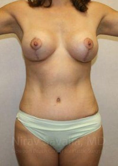 Breast Lift with Implants Before & After Gallery - Patient 1655621