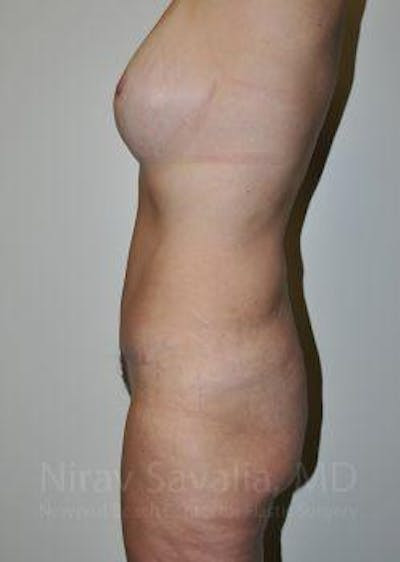 Thigh Lift Before & After Gallery - Patient 1655623 - After