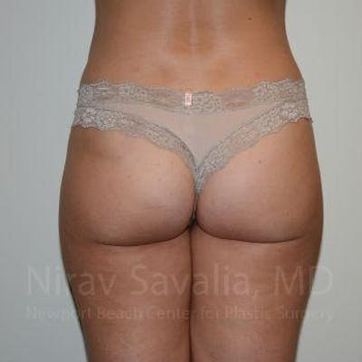 Thigh Lift Before & After Gallery - Patient 1655622
