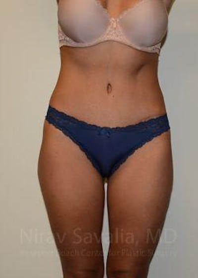 Thigh Lift Before & After Gallery - Patient 1655633
