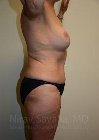 Breast Lift with Implants Before & After Gallery - Patient 1655634 - After