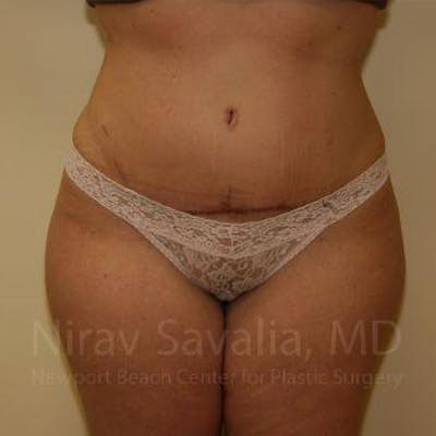 Thigh Lift Before & After Gallery - Patient 1655647
