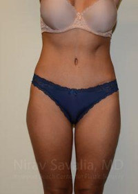 Abdominoplasty Tummy Tuck Before & After Gallery - Patient 1655645 - Image 2