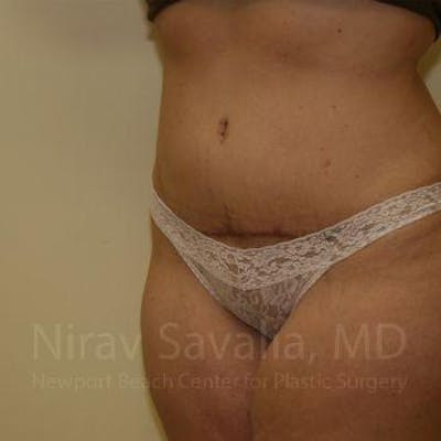 Thigh Lift Before & After Gallery - Patient 1655647 - After