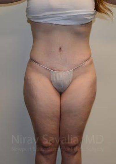 Thigh Lift Before & After Gallery - Patient 1655652