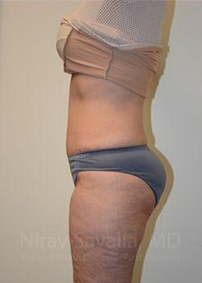 Mastectomy Reconstruction Before & After Gallery - Patient 1655654 - After