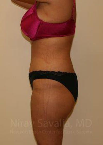 Thigh Lift Before & After Gallery - Patient 1655656 - After