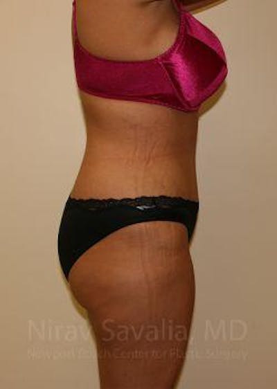 Thigh Lift Before & After Gallery - Patient 1655656 - After