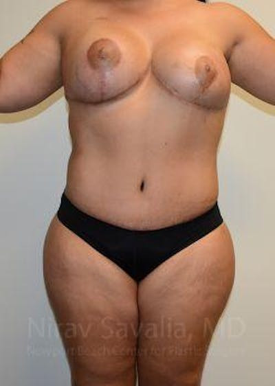 Thigh Lift Before & After Gallery - Patient 1655657