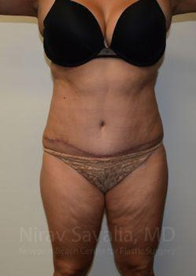 Thigh Lift Before & After Gallery - Patient 1655659