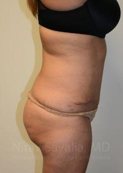Thigh Lift Before & After Gallery - Patient 1655659 - After