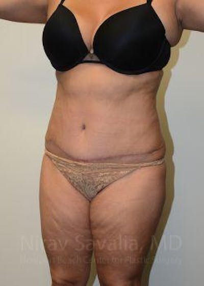 Oncoplastic Reconstruction Before & After Gallery - Patient 1655664 - After