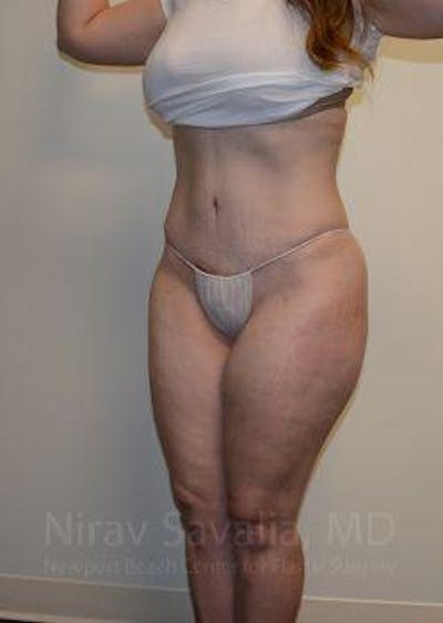 Liposuction Before & After Gallery - Patient 1655670 - After